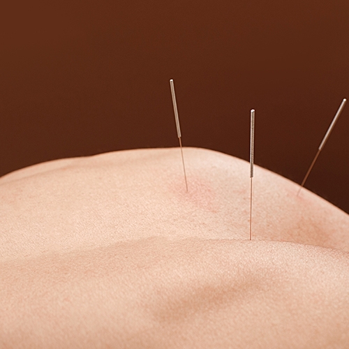 physiotherapy-center-acupuncture-lake-country-physiotherapy-Orillia-Ontario