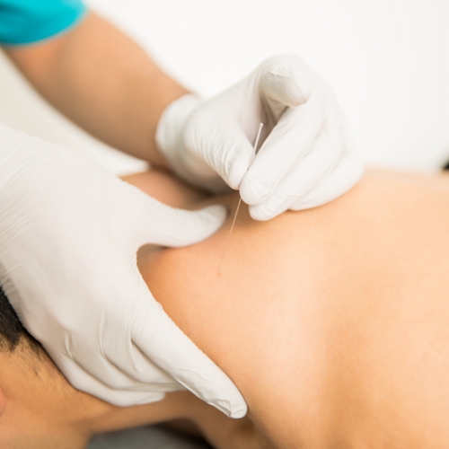 physiotherapy-center-dry-needling-lake-country-physiotherapy-Orillia-Ontario