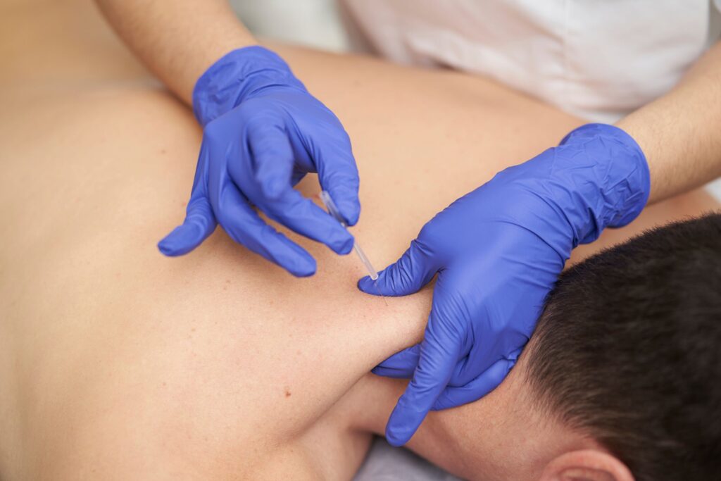 What is Dry Needling