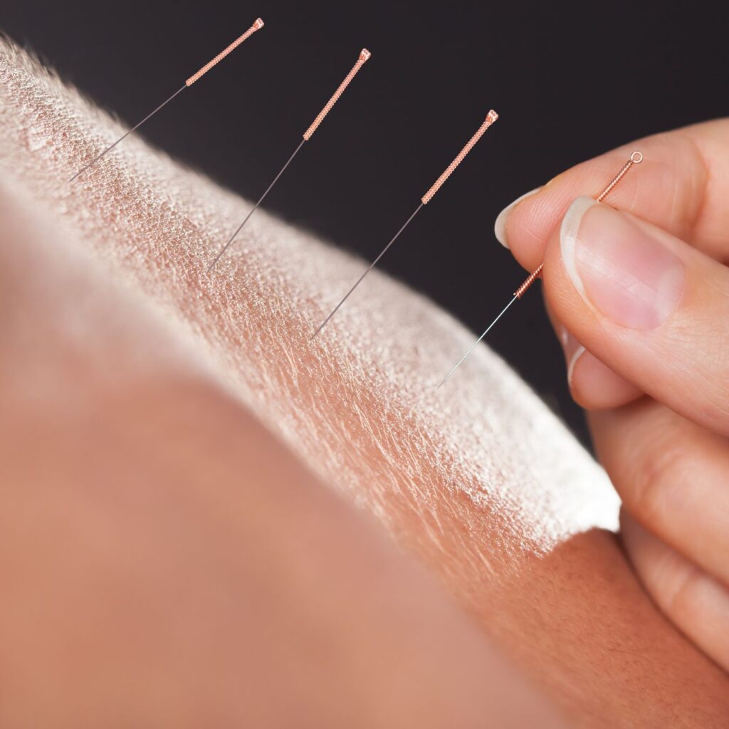 acupuncture